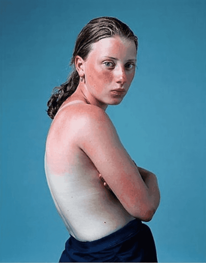 Hendrik Kerstens, ‘Sunburnt’, 2011, Print, C-Print, null, 