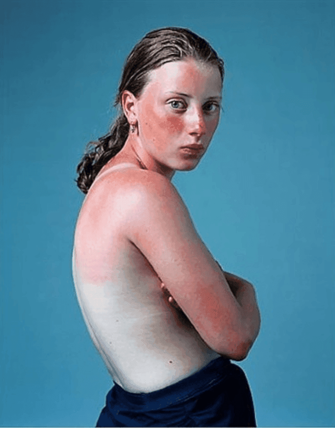 Artwork - Sunburnt